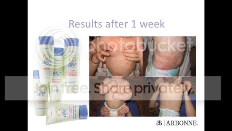 arbonne eczema