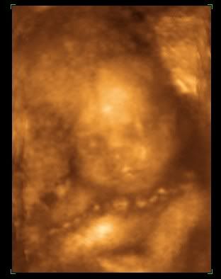 Emma 3d Ultrasound